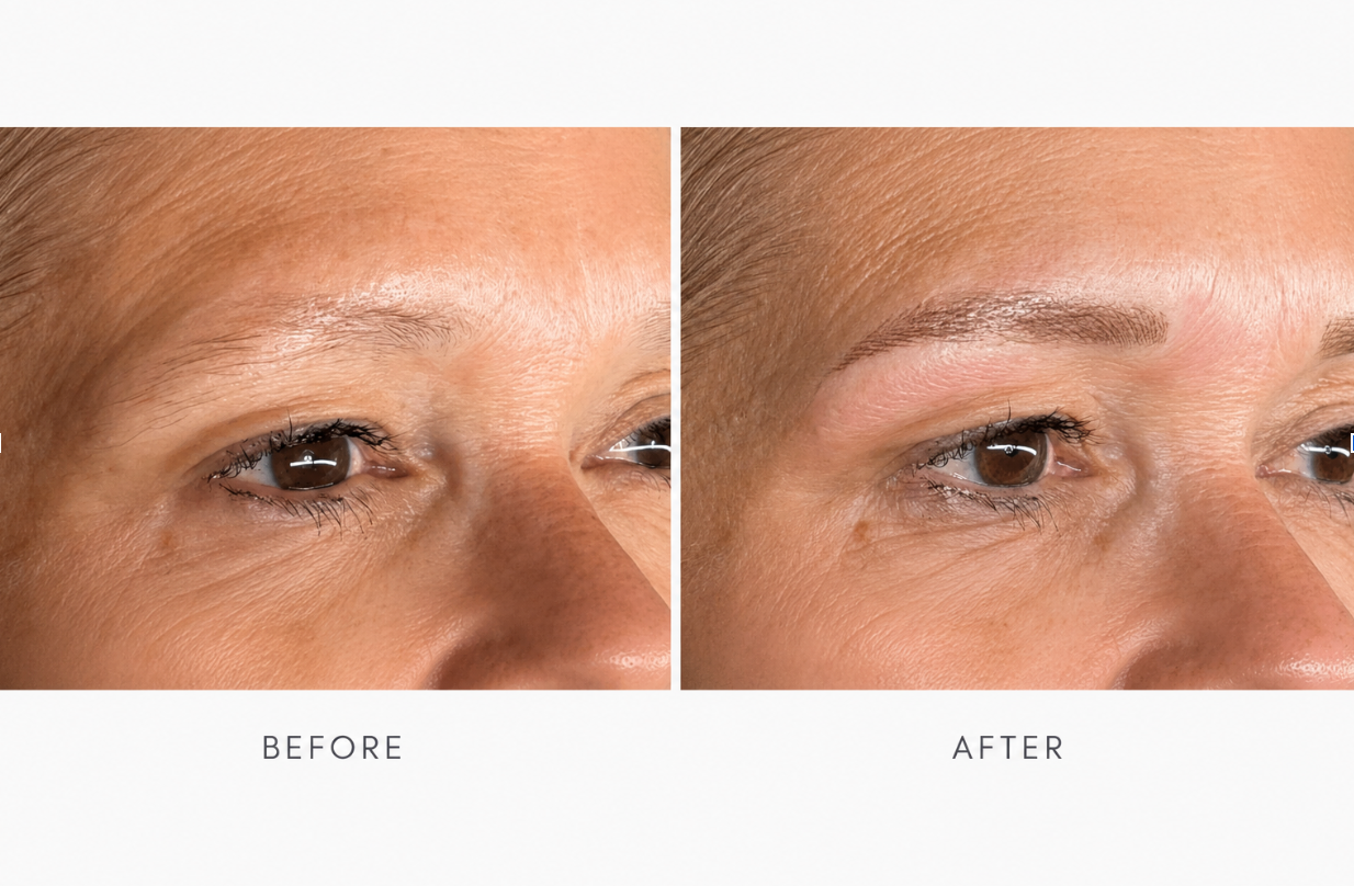 Side-by-side close-up of an eye area before and after treatment, showing reduced puffiness and smoother skin.