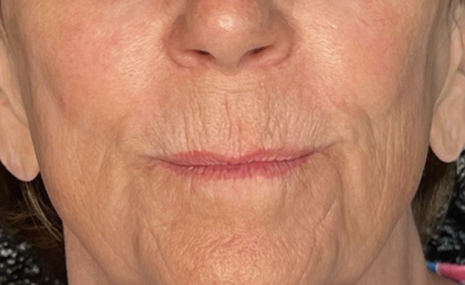Close-up of a person's mouth and lower face with visible wrinkles and neutral expression