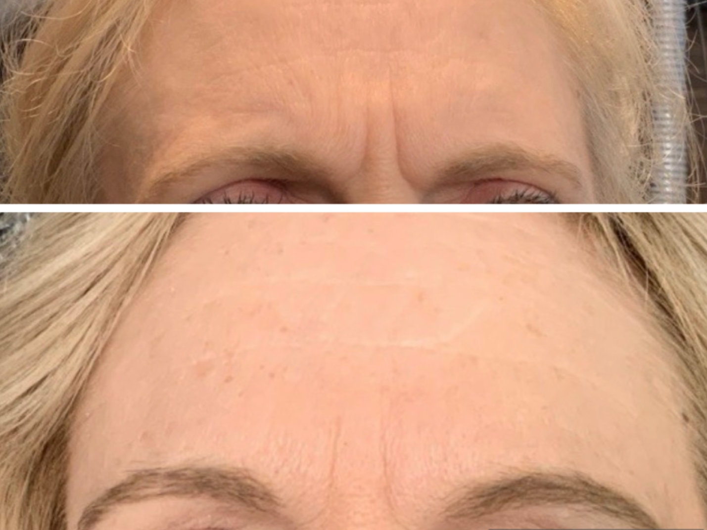 Before-and-after close-up of a forehead, showing wrinkles in the top image and smoother skin in the bottom image