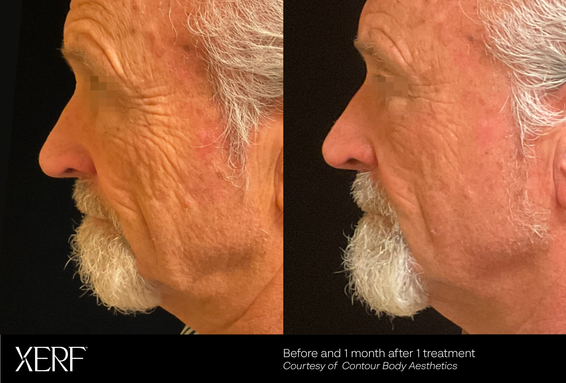 Side-by-side profile photos of a bearded man, showing a skin close-up before and after treatment.