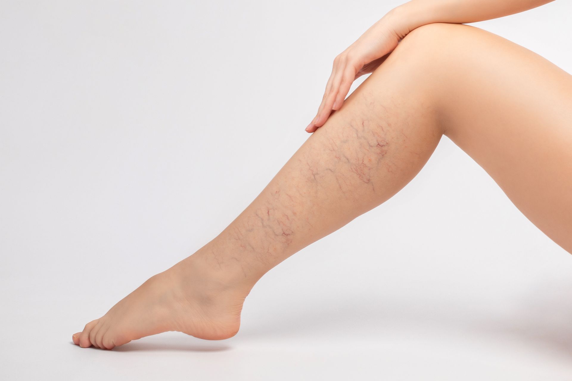 Leg of a person with visible spider veins, hand resting on thigh against a white background.