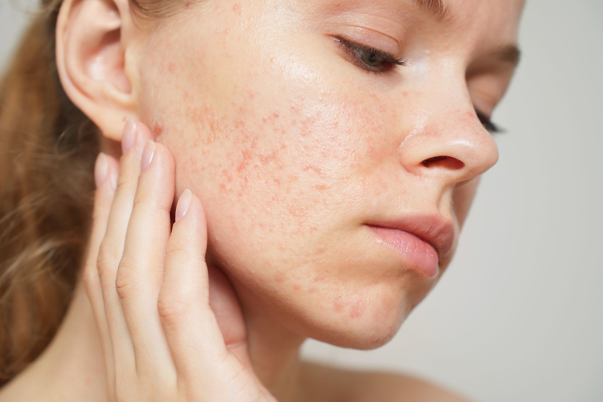 Close-up of a person touching their cheek, showing acne and blemishes on pale skin.
