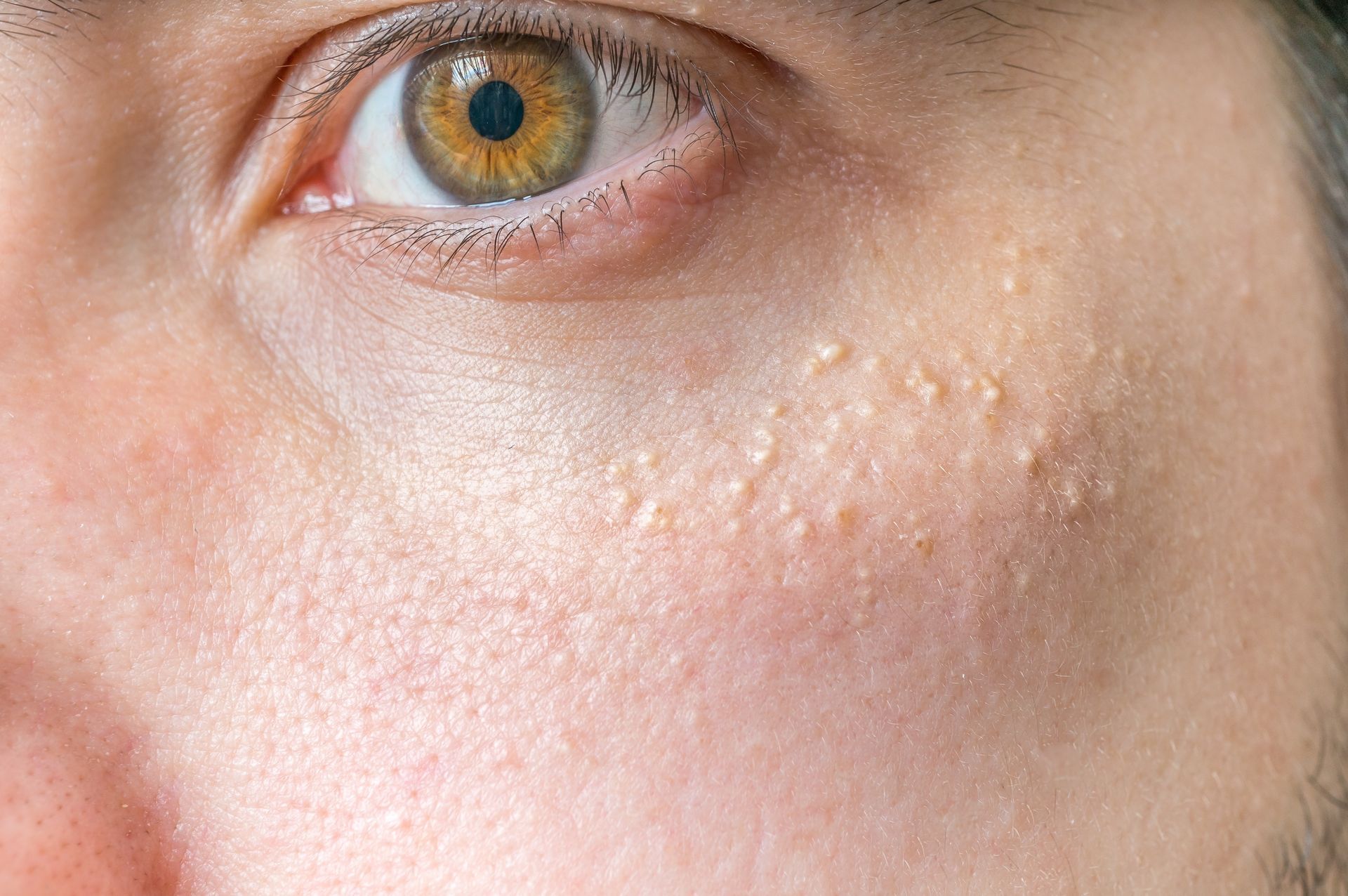 Close-up of a person's face showing skin texture with several small, raised, yellowish bumps near the eye.