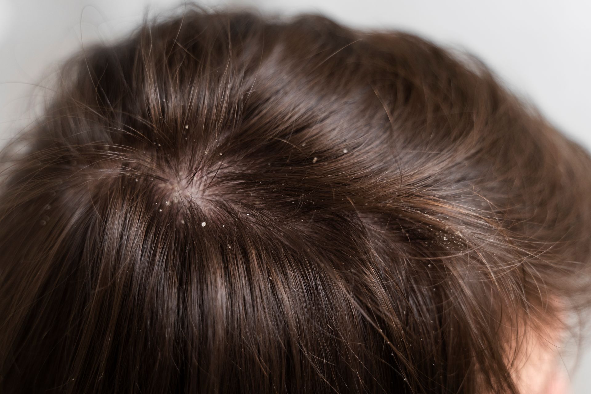 A close up of a person 's hair with dandruff.