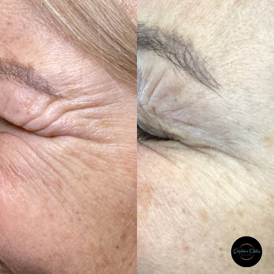Side-by-side view of an eye area: wrinkled skin on the left, smoother on the right, possibly after treatment.