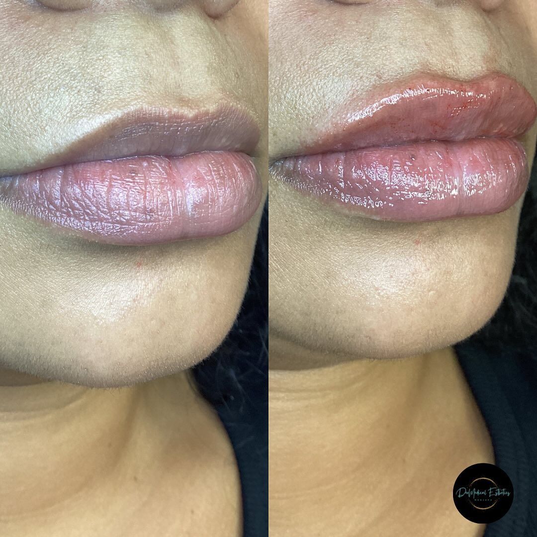 Two photos of lips, before and after lip filler treatment; lips appear fuller and glossier in the after photo.