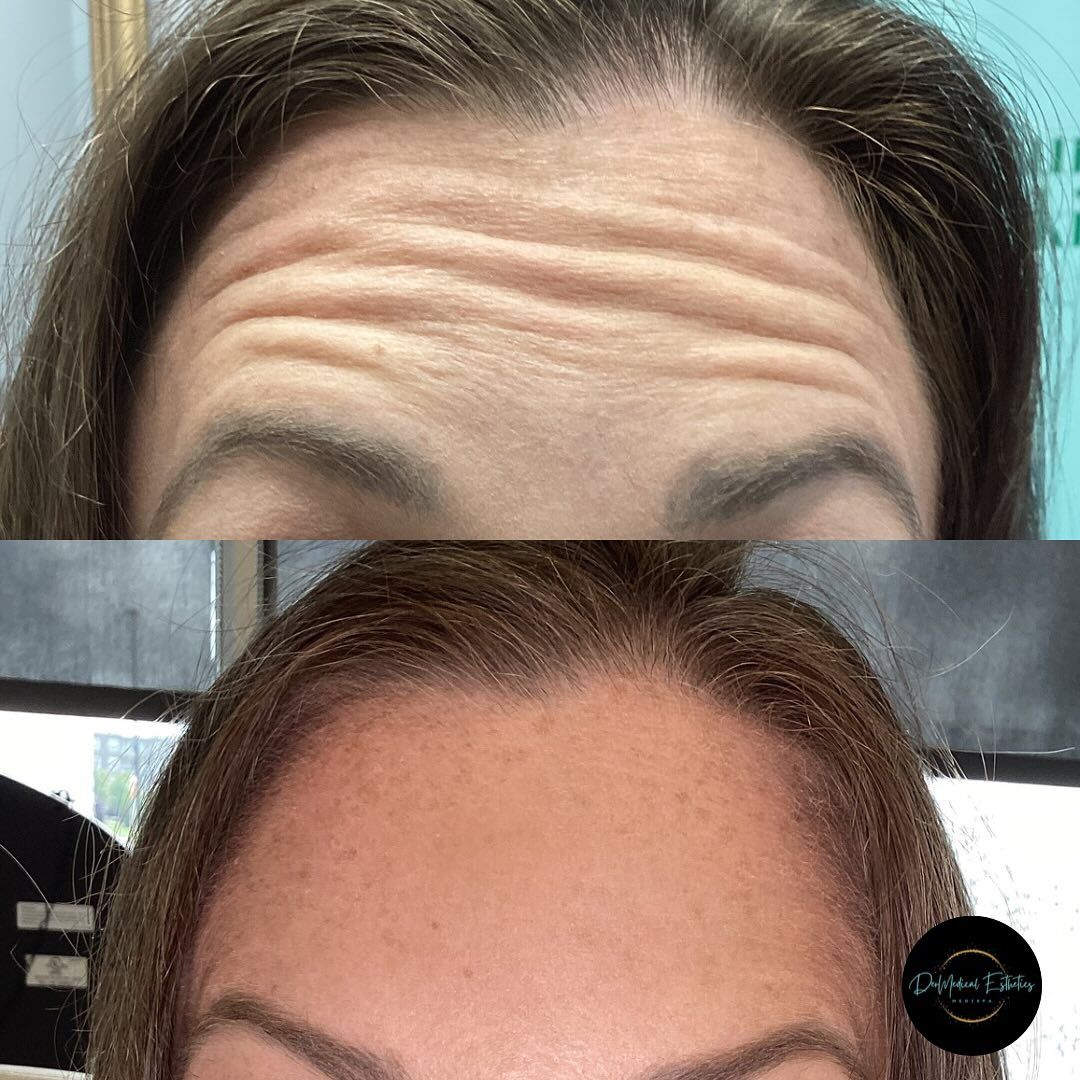 Forehead before and after treatment, showing reduction in wrinkles.