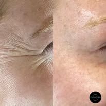 Close-up of a person's skin, left side with wrinkles, right side smoother after a procedure.