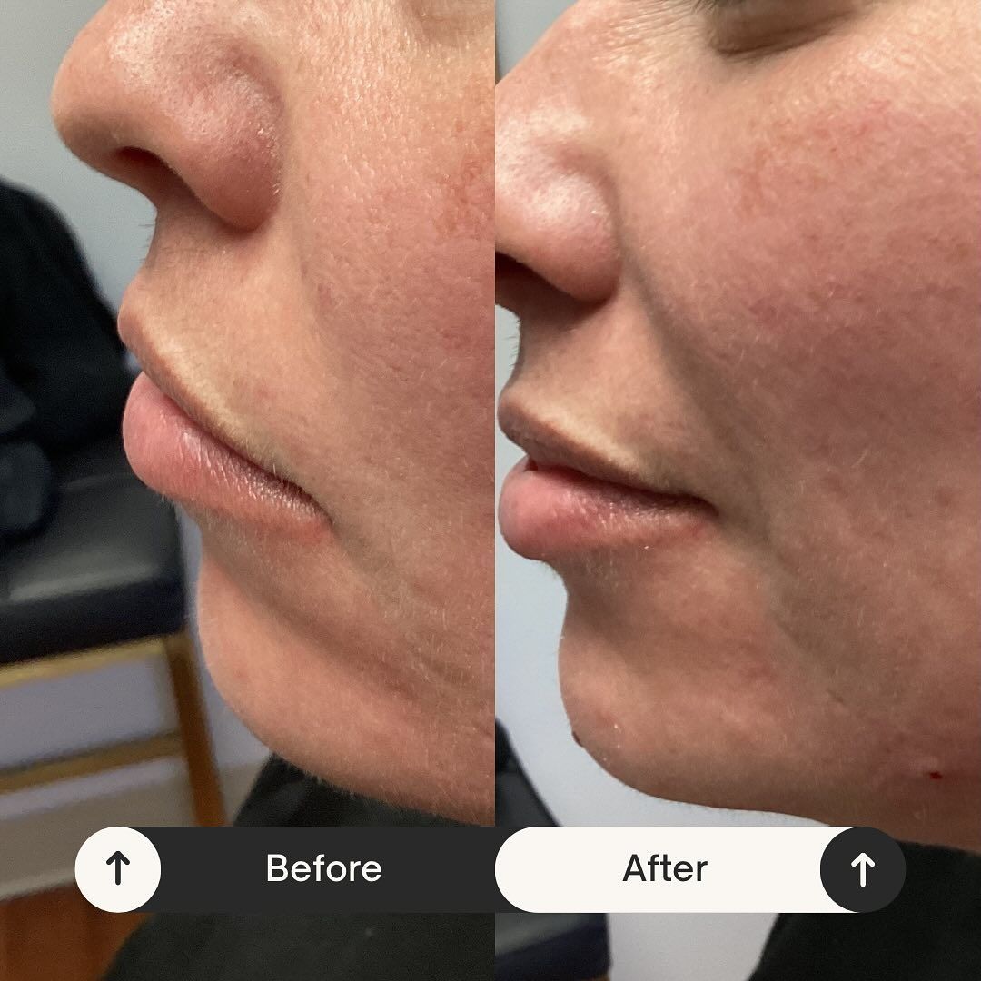 Profile view of a person's face comparing 