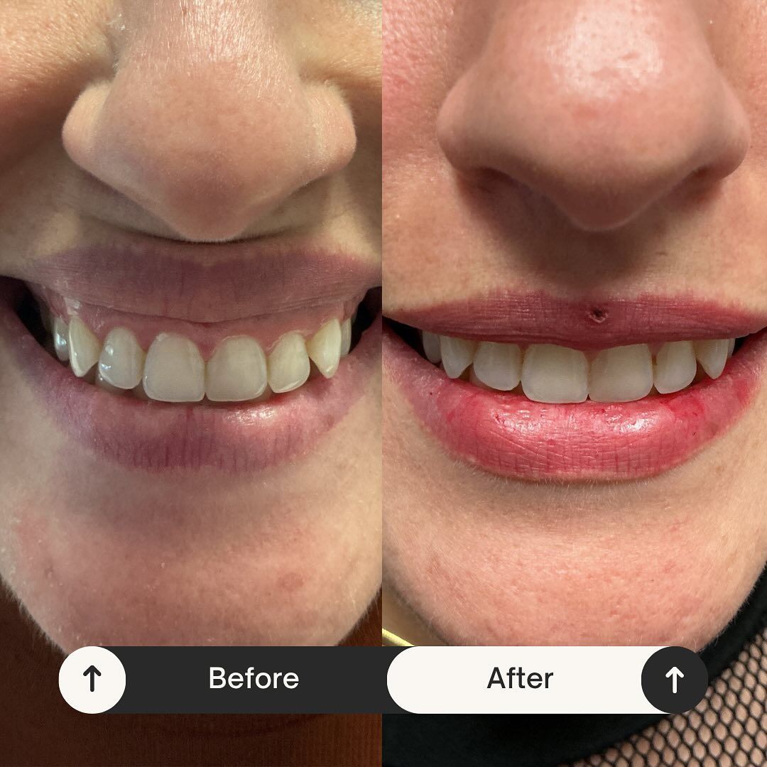 Comparison of a smile before and after a cosmetic dental procedure, showing changes to teeth and lips.