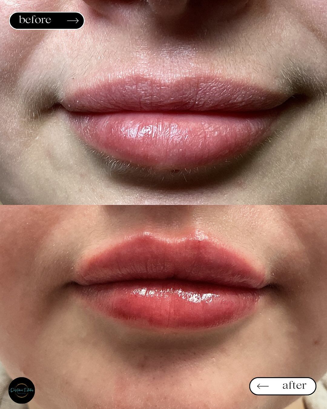 Lip enhancement comparison: top shows natural lips, bottom displays plump, red lips.