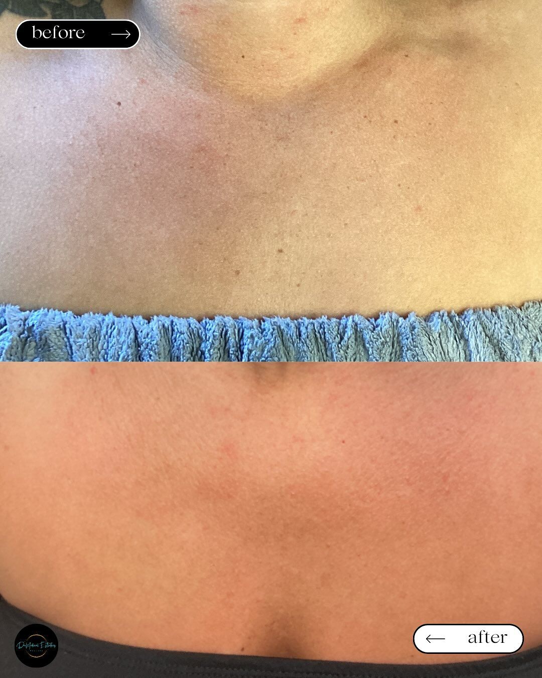 Before and after skin on the chest. The top is lighter, labeled 