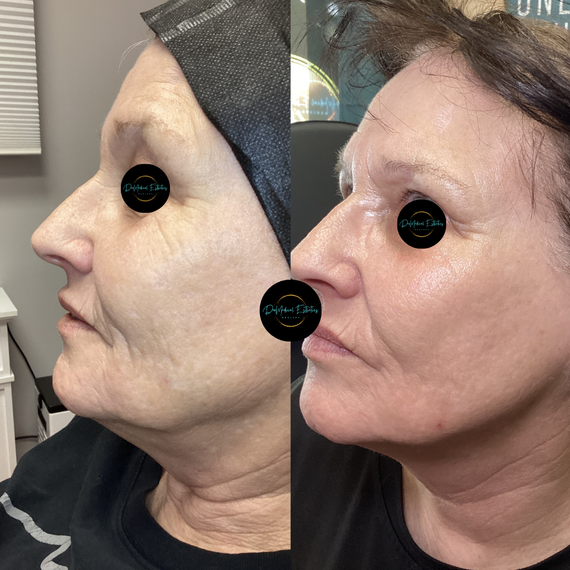 Side-by-side profile photos showing before and after skin treatment on a woman’s face.