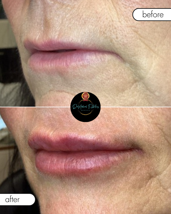 Before-and-after close-up of lips, with fuller, pinker lips shown in the bottom image.