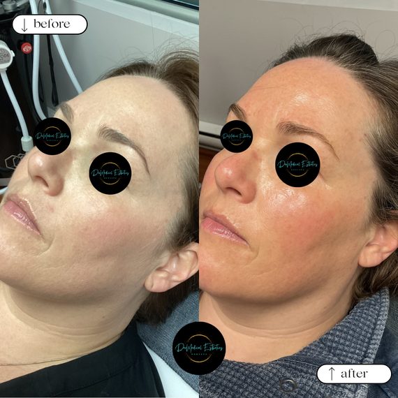 Before-and-after close-up of a woman’s face showing skin treatment results, with lighter, glossier skin after.