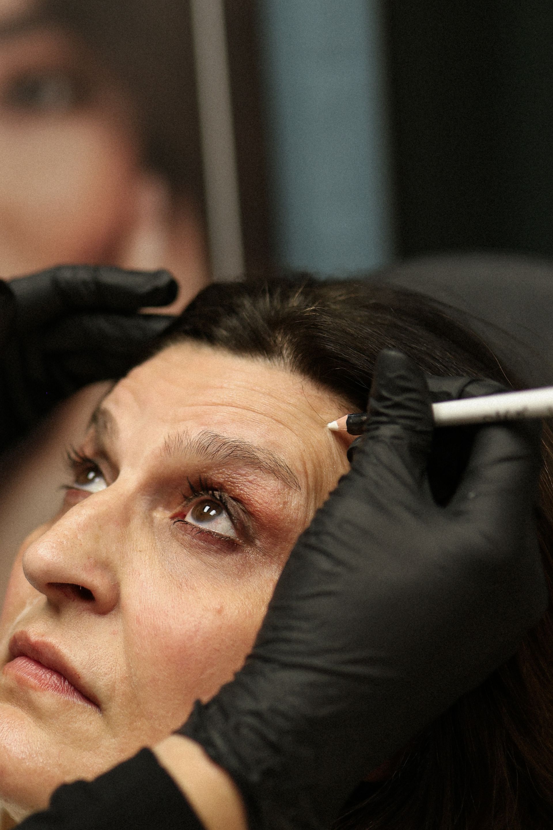 Person receiving cosmetic treatment on forehead; black-gloved hands holding a pen near the skin.