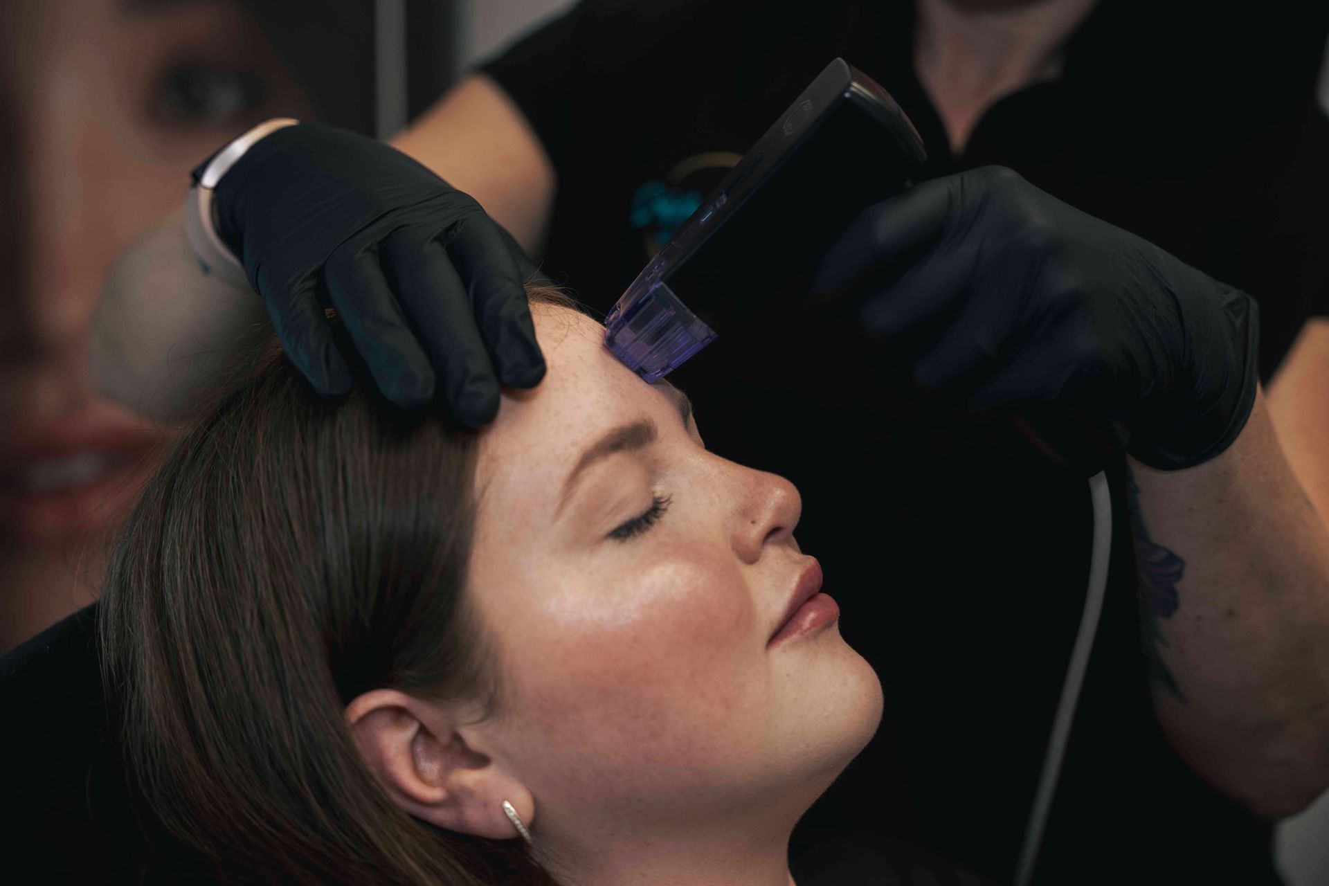 Woman receiving micro-needling treatment on her forehead; esthetician wearing black gloves.