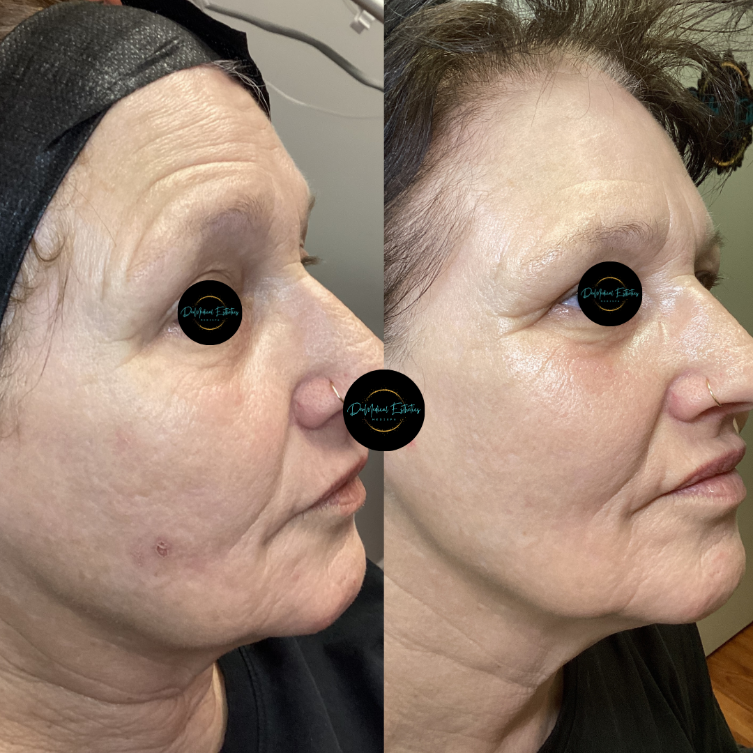 Side-by-side profile photos of the same woman showing facial changes before and after treatment.