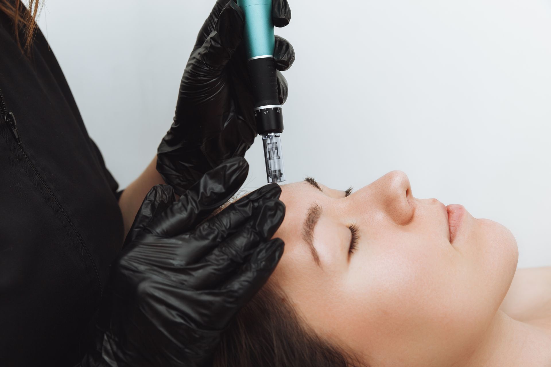 Person receiving microneedling treatment on forehead, performed by gloved hands, white background.