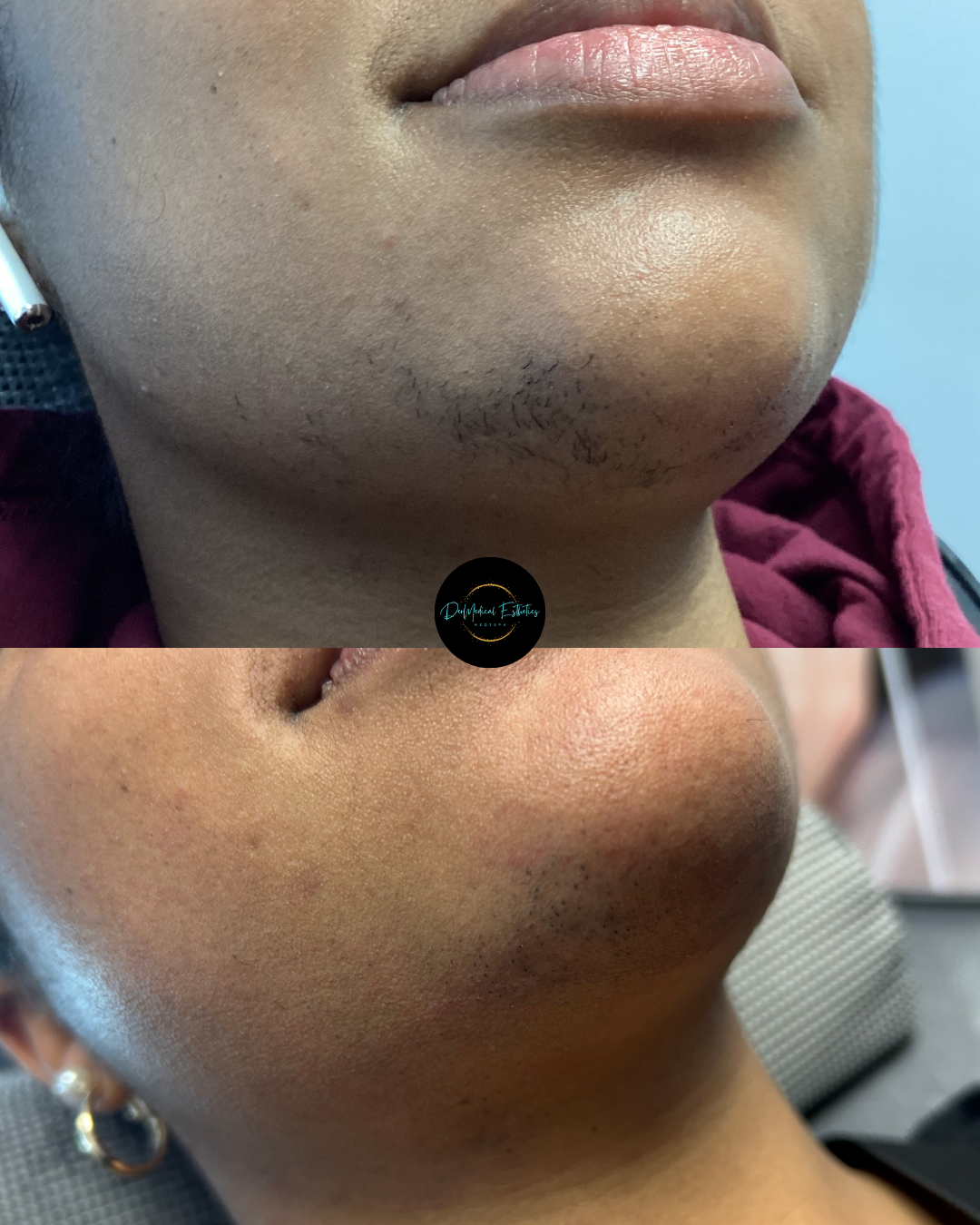 Close-up side profile of a chin and jawline with small bumps and dark spots on the skin