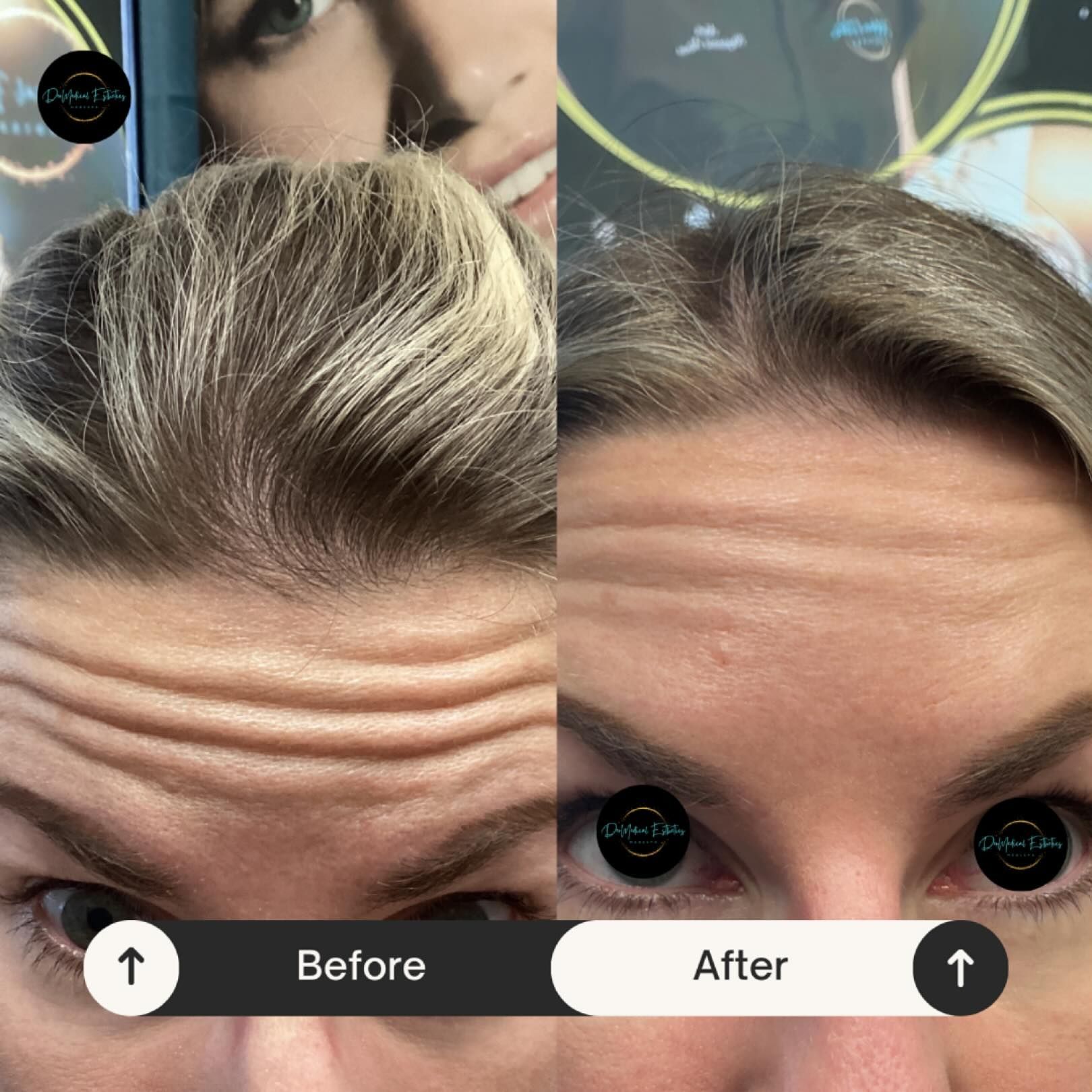 Before and after comparison of forehead wrinkles, smoothed after treatment.