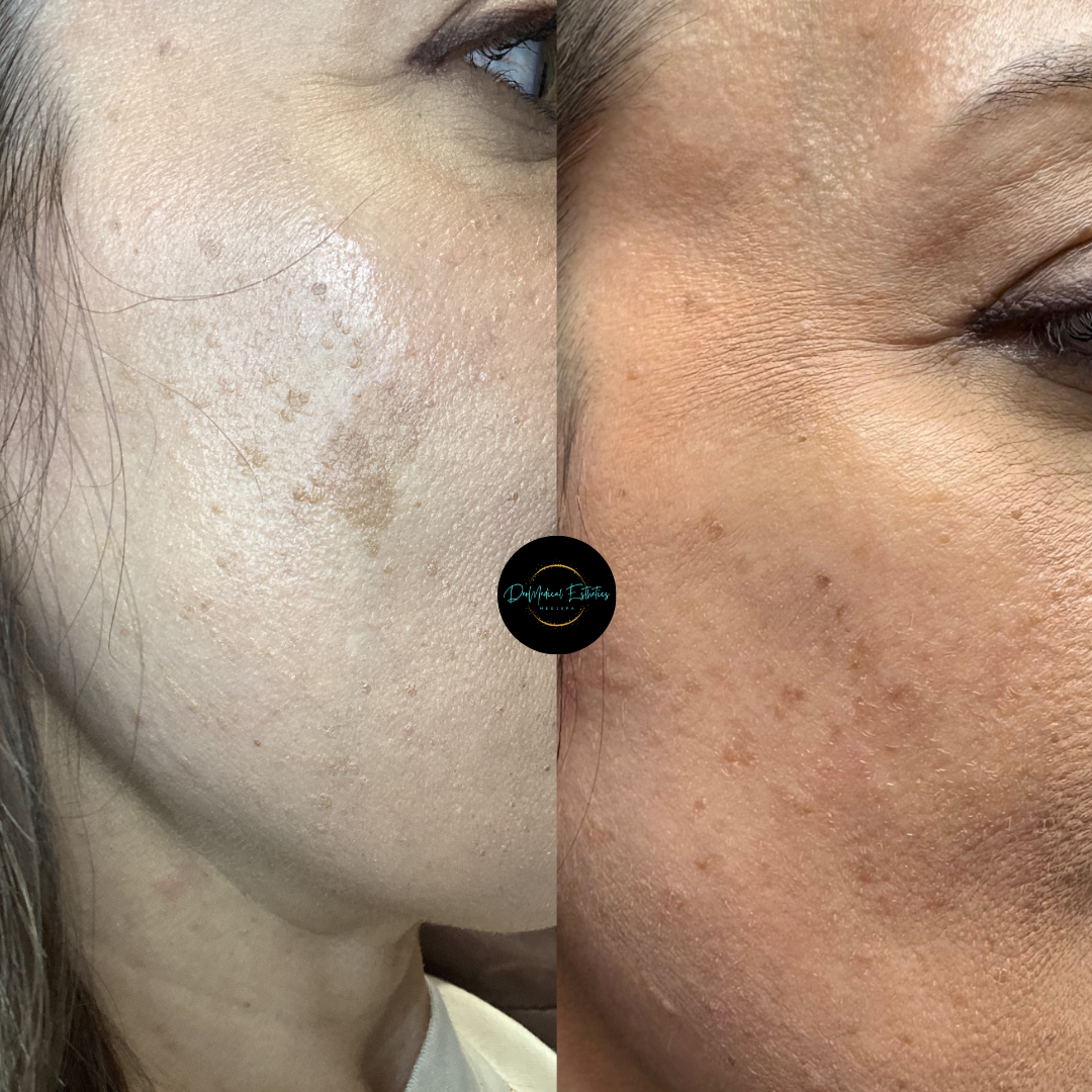 Close-up side-by-side cheek comparison showing skin texture and discoloration before and after treatment