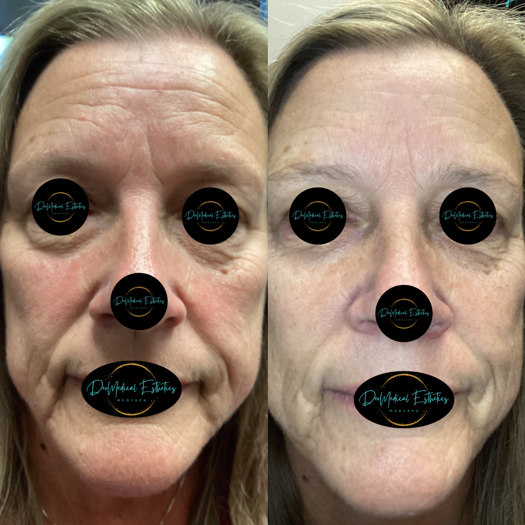 Side-by-side facial photos showing visible asymmetry, with markers over the eyes, nose, and mouth.