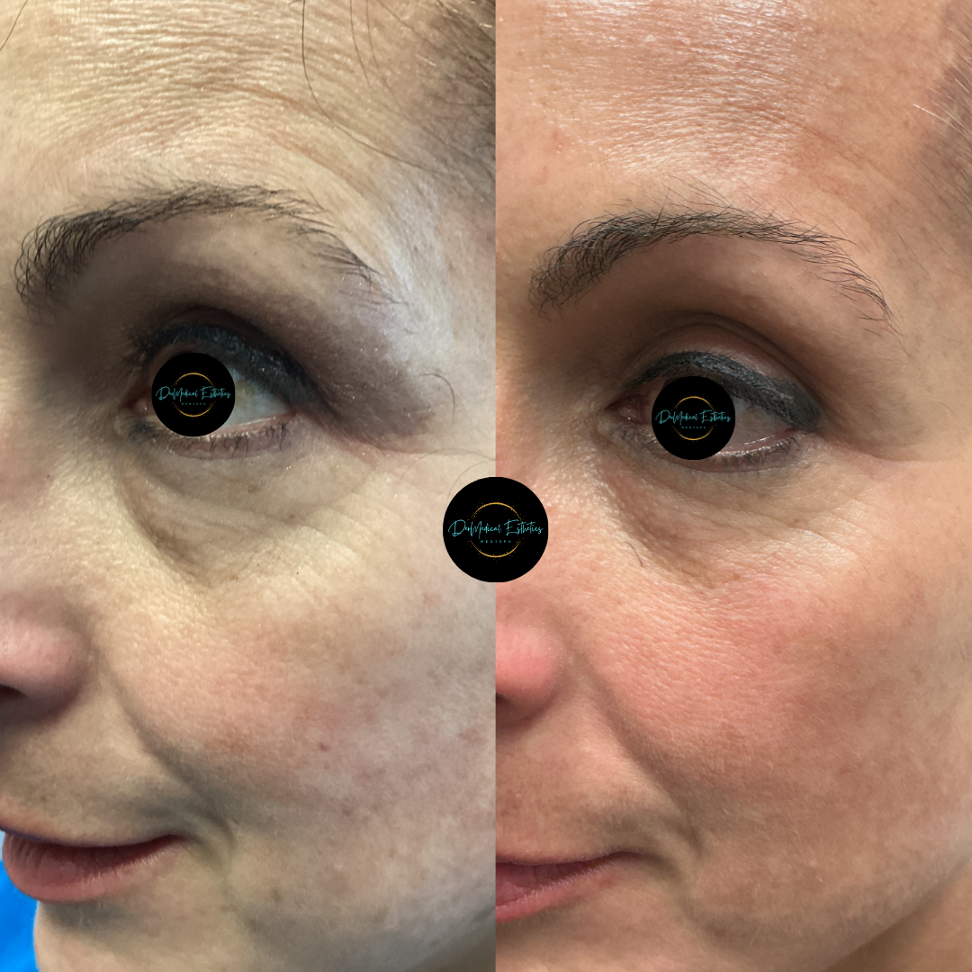 Close-up side-by-side face comparison showing under-eye area before and after makeup or treatment