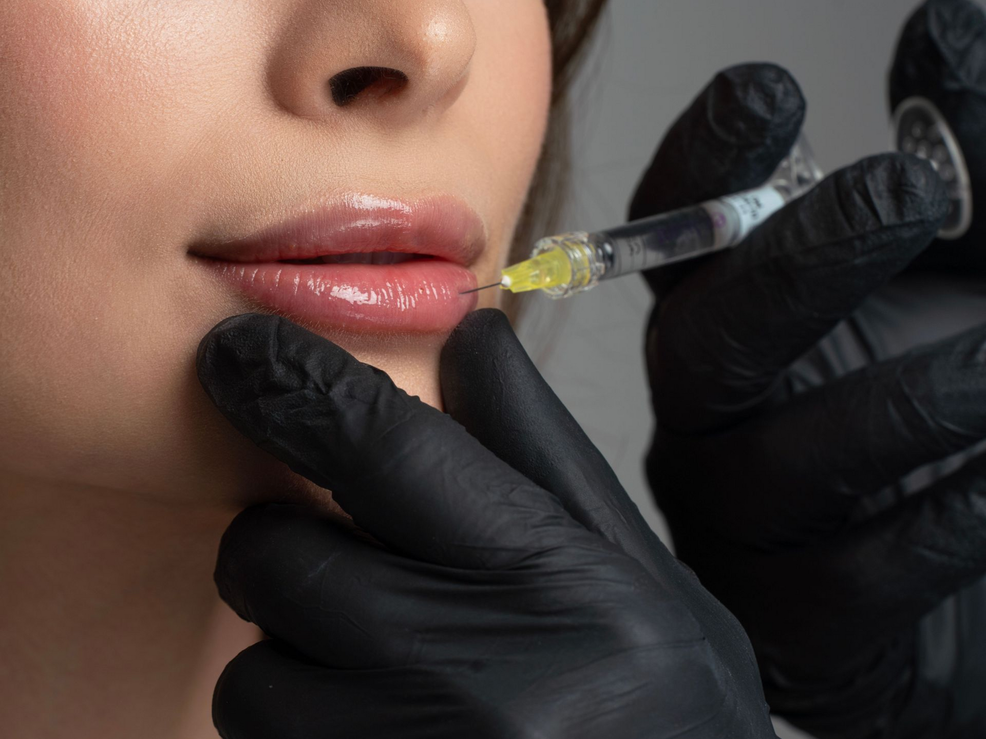 Gloved hands inject filler into a woman’s lips with a syringe