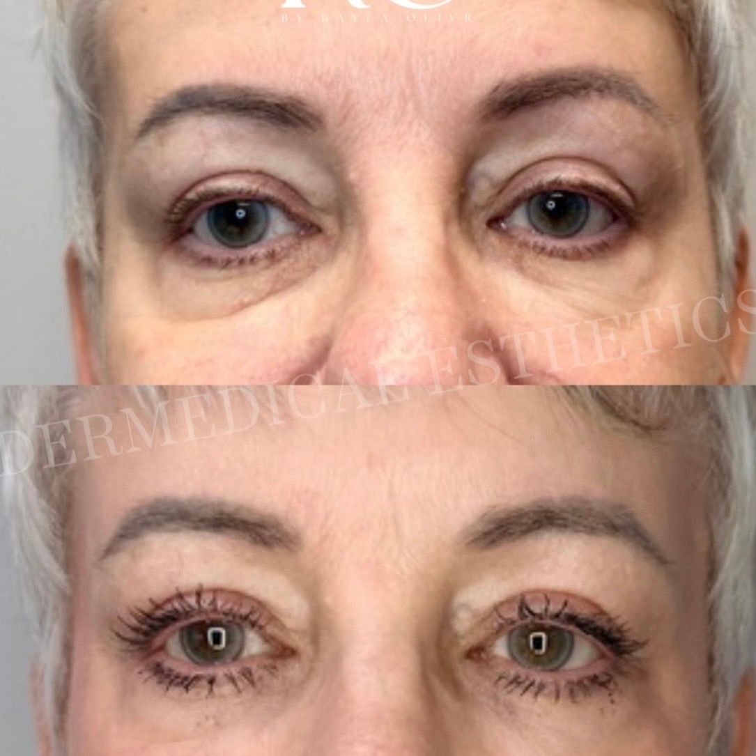 Close-up before-and-after of eyes, showing reduced under-eye bags and a smoother eyelid appearance