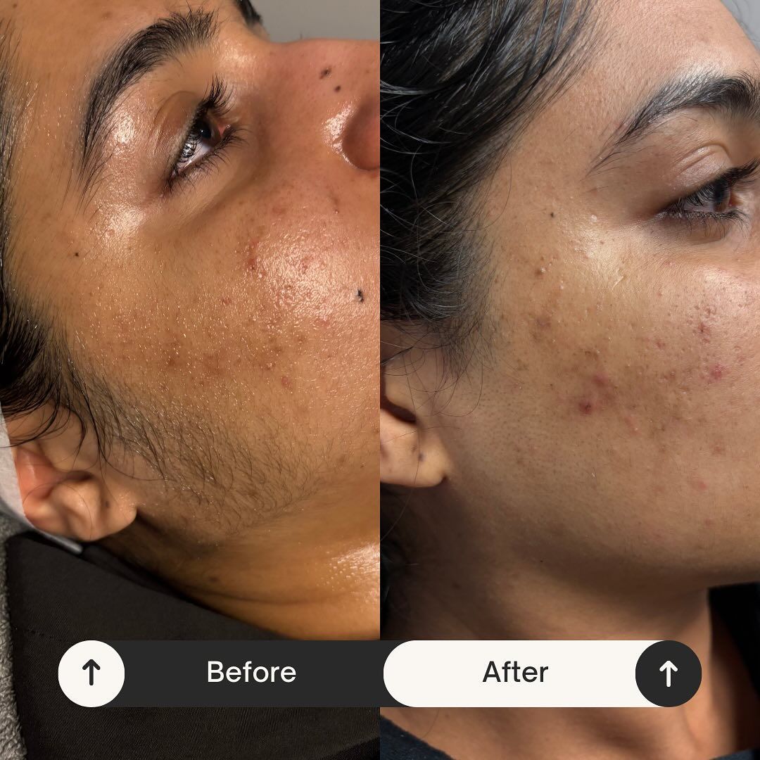 Side-by-side comparison of a person's face. Left: Before. Right: After. Shows skin changes and reduced facial hair.