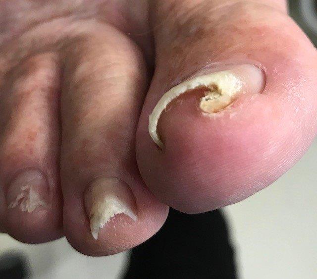 Ingrown Toenails — Orthotics in Cardiff NSW