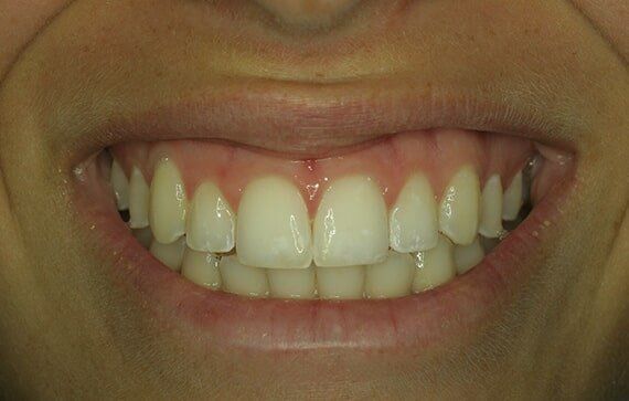 White Spot Treatment — Riviera Beach, FL — Singer Island Dentistry