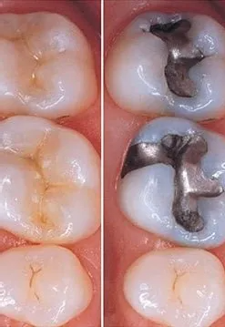 Bonding and White Fillings — Riviera Beach, FL — Singer Island Dentistry