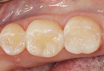Crowns — Riviera Beach, FL — Singer Island Dentistry