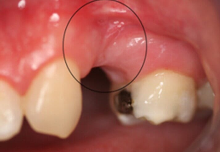Extraction Site Preservation — Riviera Beach, FL — Singer Island Dentistry