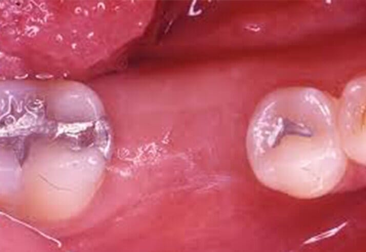 Extraction — Riviera Beach, FL — Singer Island Dentistry