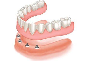 Mini – implant — Riviera Beach, FL — Singer Island Dentistry Mini – implant — Riviera Beach, FL — Singer Island Dentistry