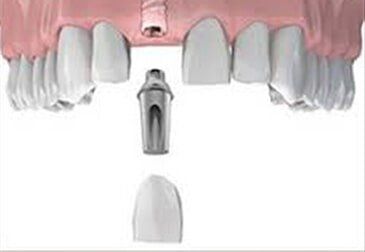 Tooth Implants — Riviera Beach, FL — Singer Island Dentistry Tooth Implants — Riviera Beach, FL — Singer Island Dentistry