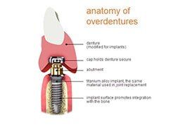 Anatomy of Overdenture — Riviera Beach, FL — Singer Island Dentistry Anatomy of Overdenture — Riviera Beach, FL — Singer Island Dentistry