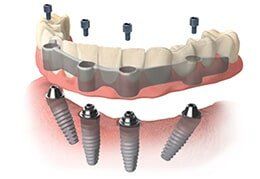 Hybrid Implant — Riviera Beach, FL — Singer Island Dentistry Hybrid Implant — Riviera Beach, FL — Singer Island Dentistry