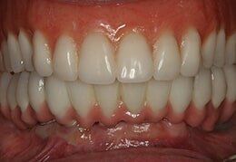 Complete Teeth — Riviera Beach, FL — Singer Island Dentistry Complete Teeth — Riviera Beach, FL — Singer Island Dentistry