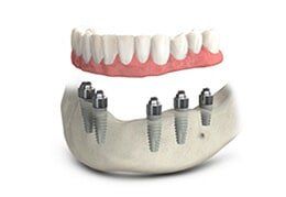 Implant — Riviera Beach, FL — Singer Island Dentistry Implant — Riviera Beach, FL — Singer Island Dentistry