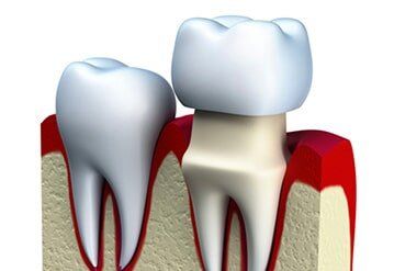 Dental Crown Installation — Riviera Beach, FL — Singer Island Dentistry