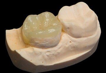 Non-Metal Onlay — Riviera Beach, FL — Singer Island Dentistry