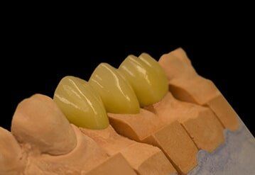 Cermet Bridge — Riviera Beach, FL — Singer Island Dentistry