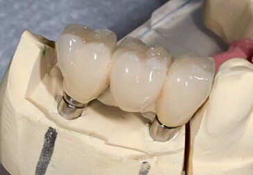 Dental Implant to Three Elements — Riviera Beach, FL — Singer Island Dentistry Dental Implant to Three Elements — Riviera Beach, FL — Singer Island Dentistry