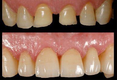 Before And After of Veneer — Riviera Beach, FL — Singer Island Dentistry