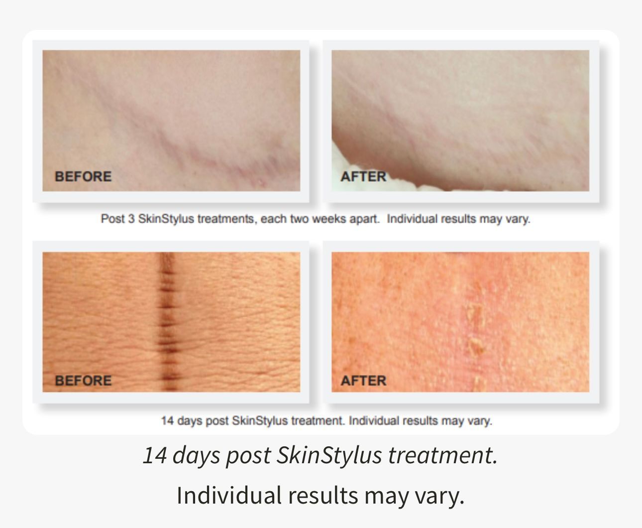 Surgical Scars, Stretch Marks with Microneedling Pen