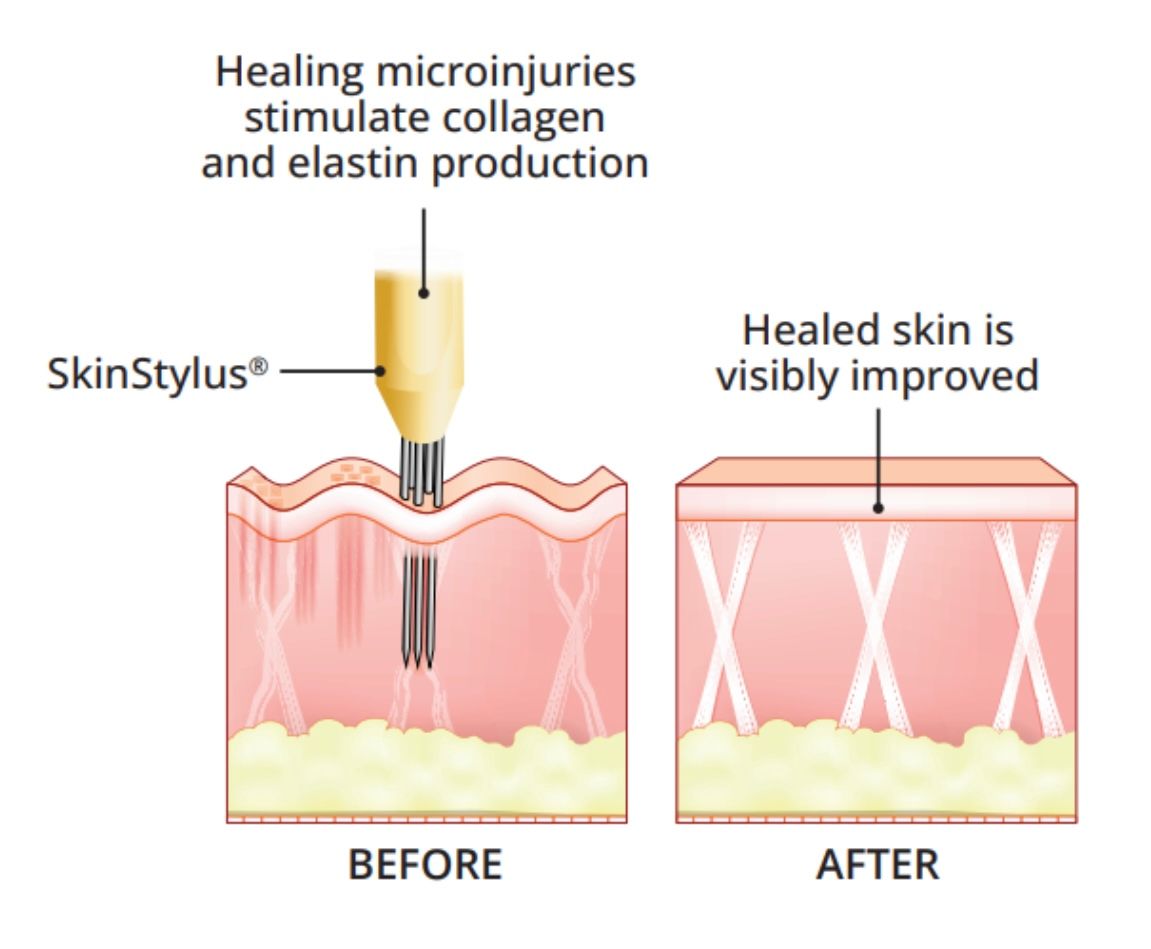 Stimulates Collage and Elastin to resurface the skin